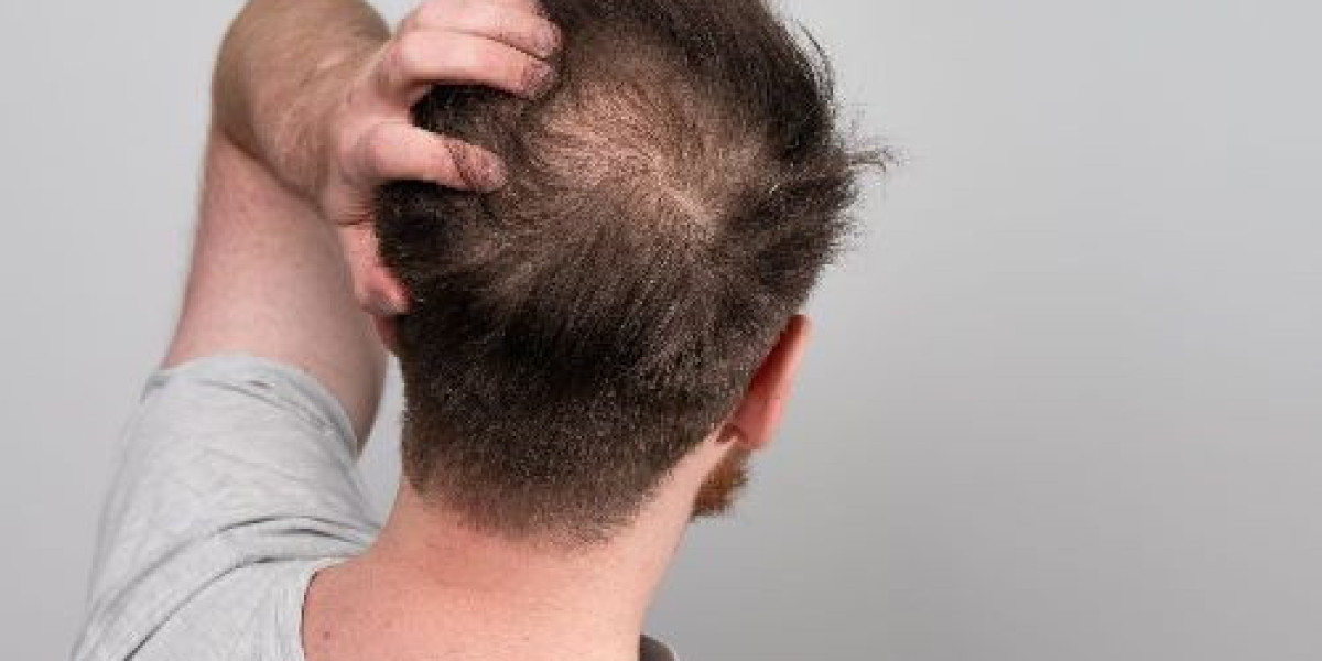 Beach Day Guidelines After Hair Transplant Surgery
