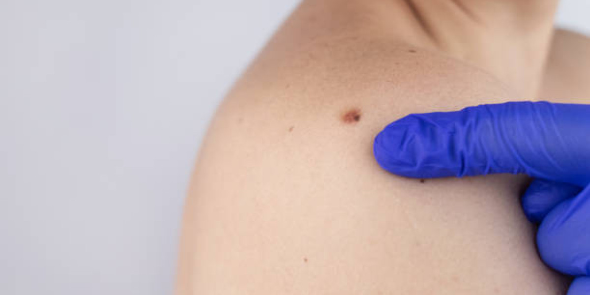 Wart Removal: Safe Solution for Facial Warts Now