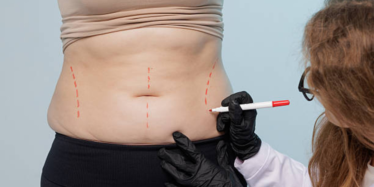Liposuction Procedure Targets Fibrous Fat Deposits