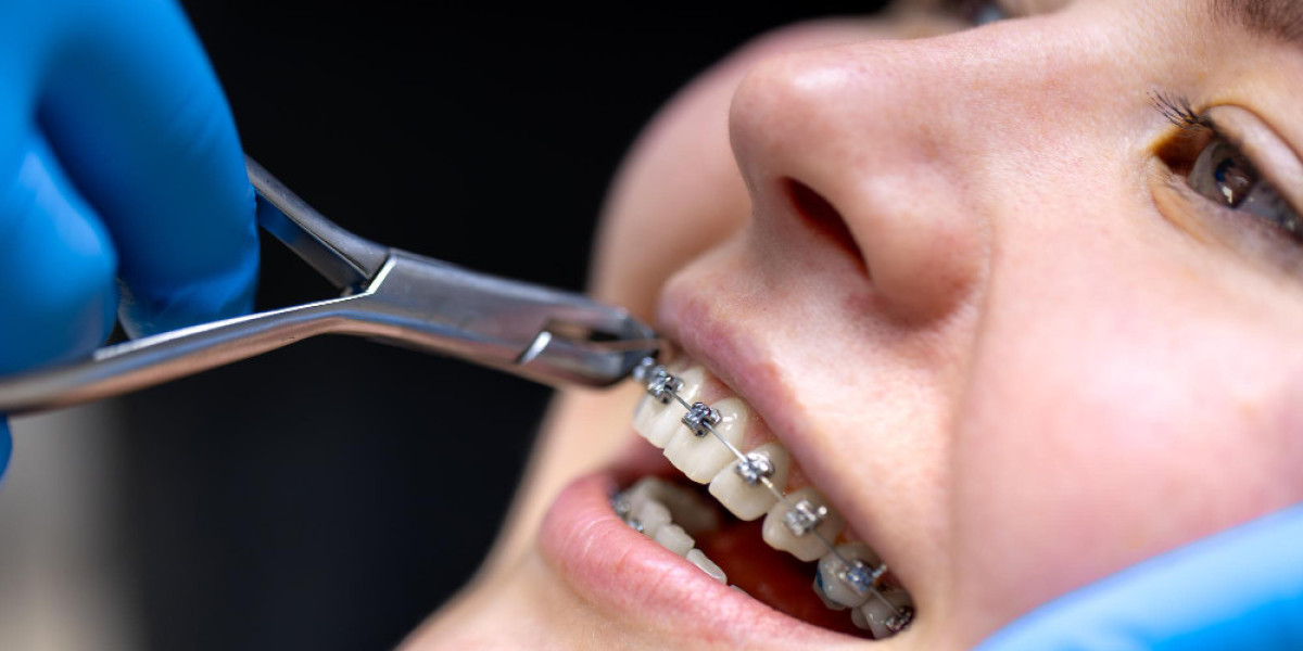 Damon Braces Treatment in Indirapuram for a Perfect Smile