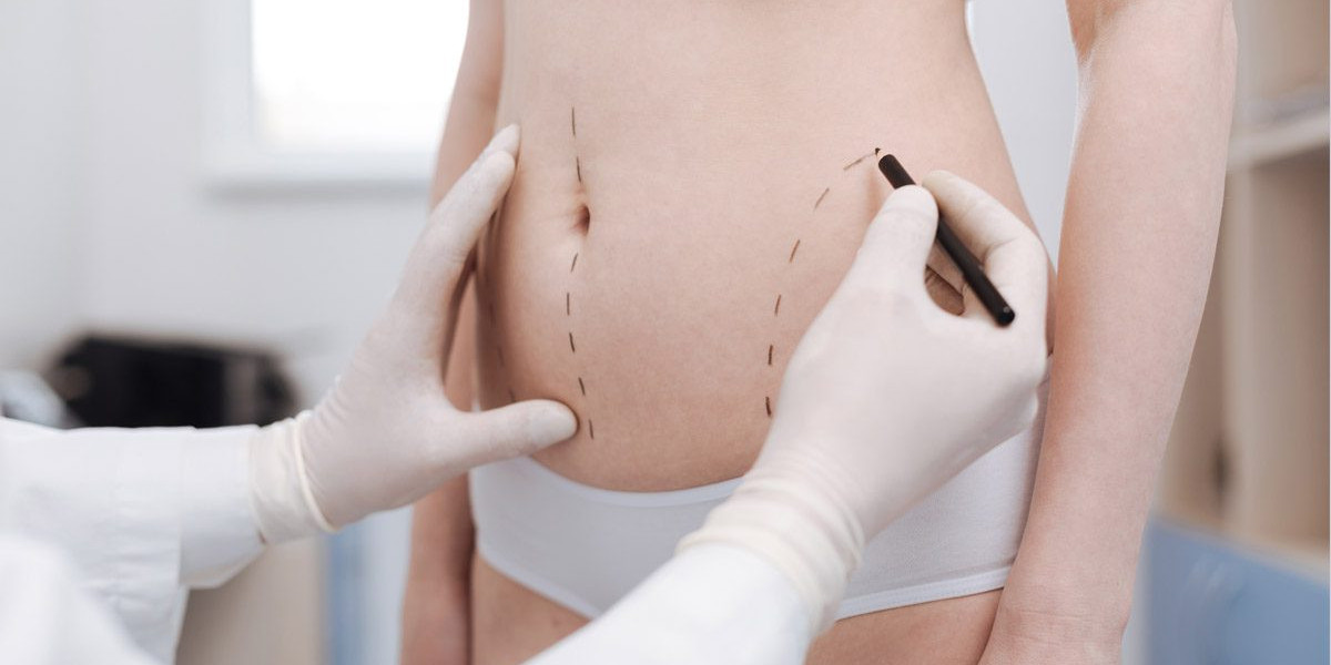 Liposuction in Dubai: The Smart Choice for Effective Fat Reduction
