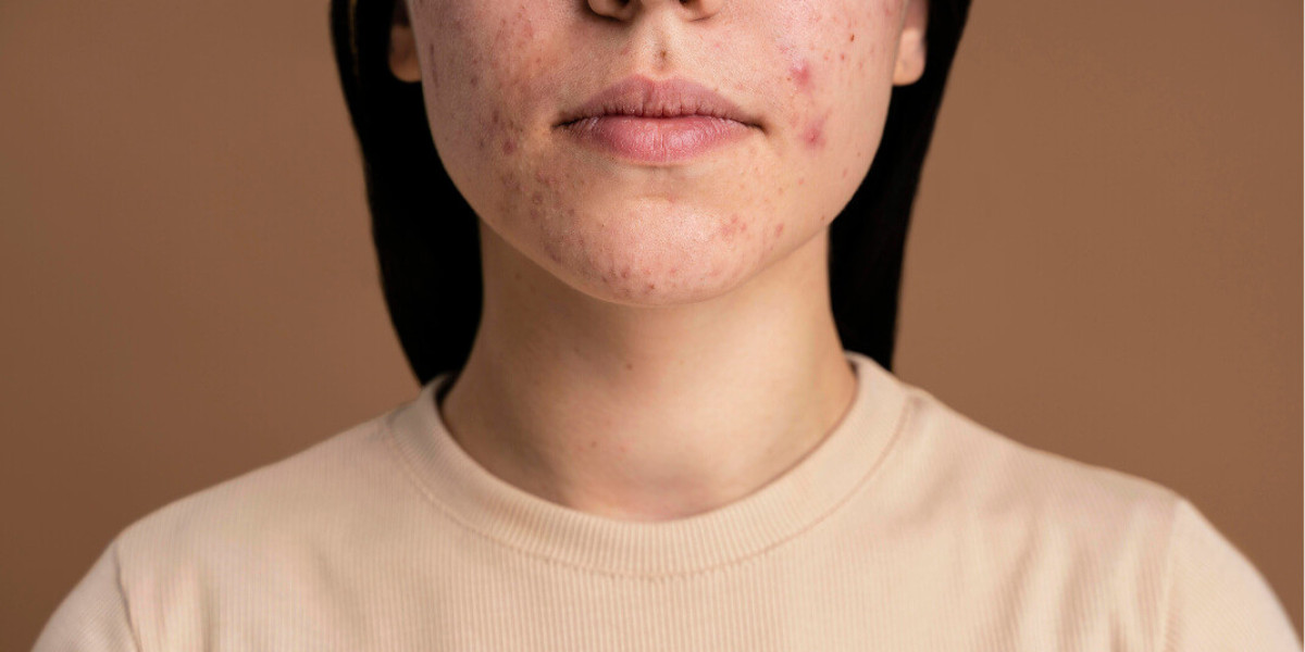 Why Acne Scar Treatment is Different For Each Person?