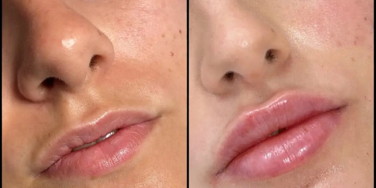 Fillers in Dubai for Instant Facial Rejuvenation