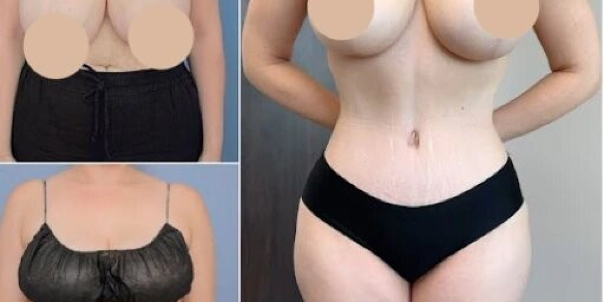Enhance Your Natural Curves with Tummy Tuck in Dubai