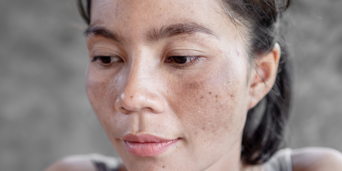 Melasma Treatment in Islamabad: Is It Suitable for All Skin Types?