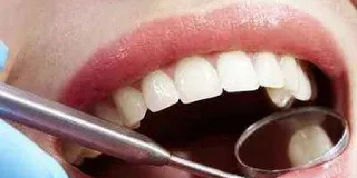 Dental Crown Treatment in Islamabad for Advanced Tooth Protection, Restoration, and Smile Transformation